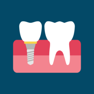 Midland Bay Dental Services - Implants