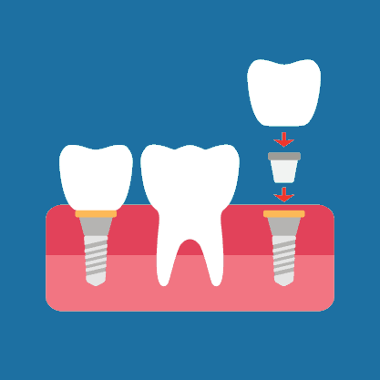 Midland Bay Dental Implants