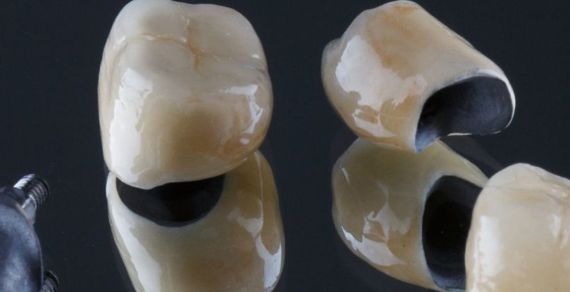 Crown and Bridge: Ideal Option for Natural-Looking Tooth Replacement
