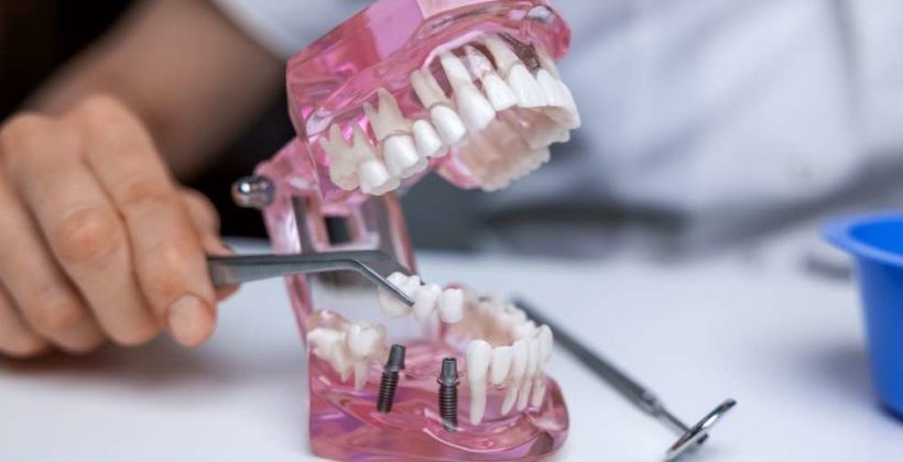 Dental Bridges vs Implants: What’s The Difference and Which Is Right For You