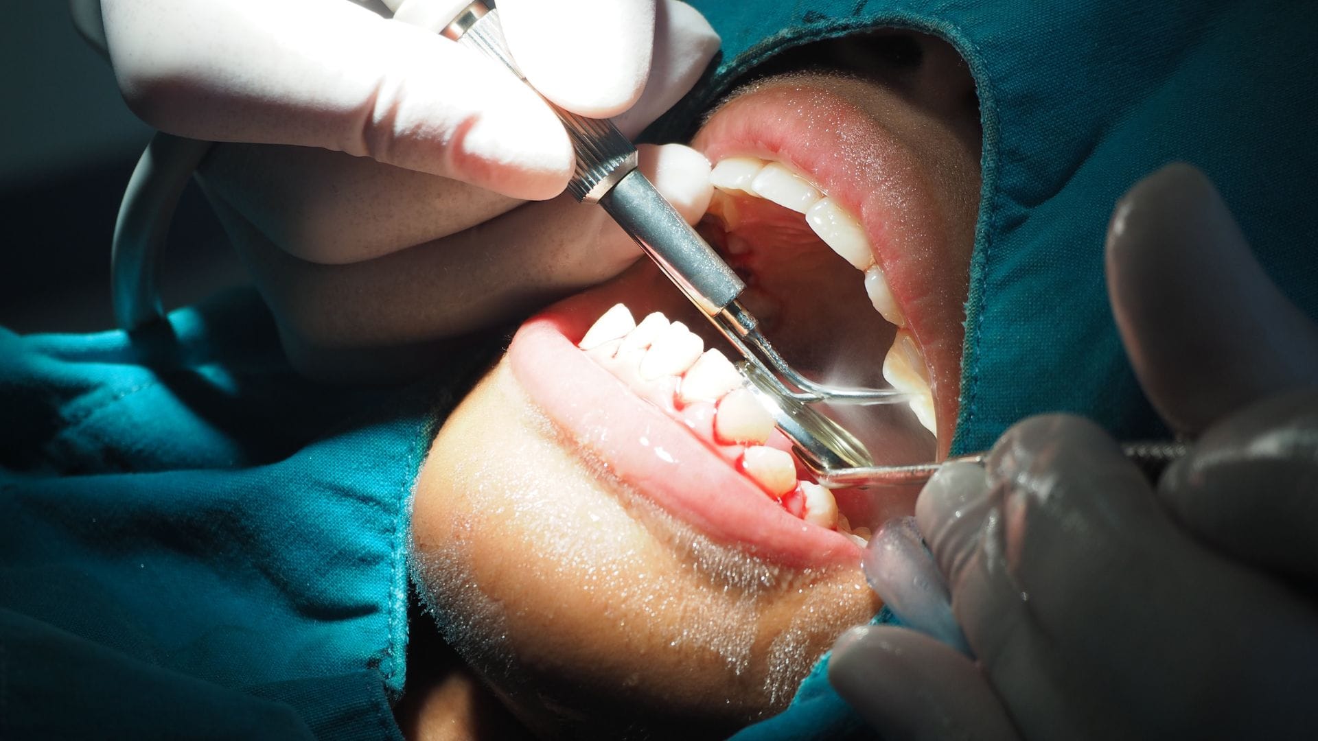 Gum disease symptoms - getting a cleaning with Midland Bay Dental.